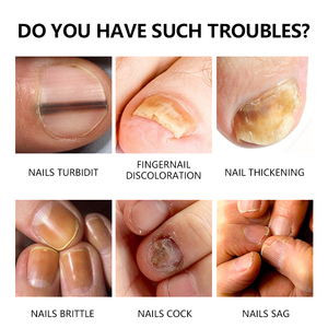 Traitement <span class=keywords><strong>des</strong></span> <span class=keywords><strong>ongles</strong></span> anti-fongique Tuer les champignons Restaurer les <span class=keywords><strong>ongles</strong></span> Pas de produits chimiques durs Résultats justes Traitement <span class=keywords><strong>des</strong></span> <span class=keywords><strong>ongles</strong></span> acides Réparation <span class=keywords><strong>d</strong></span>écolorée - Product Image 3