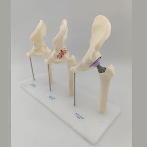 KyrenMed 3-ступенчатая модель лечения и замены остеоартрита тазобедренного имплантата - Product Image 4