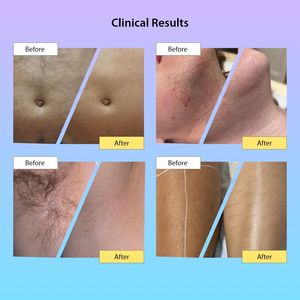 Macchina di depilazione del <span class=keywords><strong>Laser</strong></span> a diodi indolore 3 in 1 755 808 l'attrezzatura di bellezza 1064nm - Product Image 5