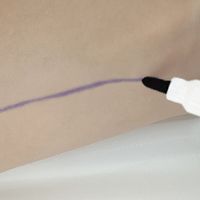 Marqueur violet stérile Medline, non toxique, sûr pour la peau, effaçable à sec et à l'eau, pointe de 2 mm