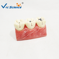 Modelo de Caries Dental de 3 Etapas, Ampliado 5 Veces, Dientes Desmontables para Educación en Patología Oral, CE ISO ROHS CNAS