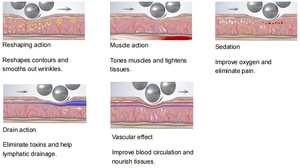 <span class=keywords><strong>Appareil</strong></span> de massage amincissant à rouleaux 1000W, machine de pressothérapie lymphatique, <span class=keywords><strong>appareil</strong></span> de drainage lymphatique par aspiration à rouleaux - Product Image 3