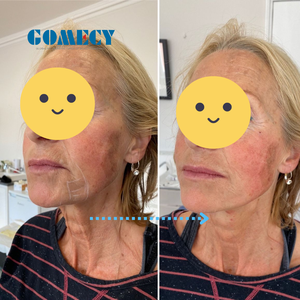 Máquina Multifunción de Liposucción Quirúrgica con Láser de Diodo de 980nm+1470nm, Liposucción Endoláser, Lifting Facial y de Cuello - Product Image 5