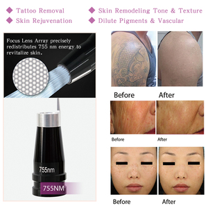 Precio de Fábrica, Máquina de Depilación Láser de Diodo de 1600W, Láser de Diodo 808, Ice Platinum Titanium - Product Image 3