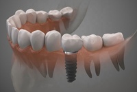 INONE 3d poudre titane 3d métal poudre imprimante 3d métal poudre BT6/Ti64/Cp Ti/TiAl alliages de titane impression 3d