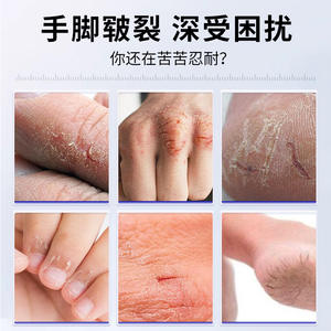 Crema Frostbite para el cuidado de los pies con glicerina, hidratante y antiagrietamiento para piel seca en adultos - Product Image 4