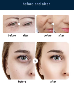 Generation Therm Non Invasive Fractional System for Non-Invasive Anti Medical EstheticianAging Skin Tightening - Product Image 5