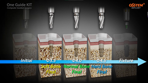 Original Universal One <strong>Guide</strong> Kit <strong>Dental</strong> <strong>Implant</strong> <strong>Surgical</strong> Complete Drill Bit Kit - Product Image 6