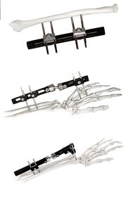 Profesional Of-<span class=keywords><strong>Distal</strong></span> <span class=keywords><strong>Radius</strong></span> Fixator B pergelangan tangan sendi ortopedi tulang eksternal Fixator - Product Image 4