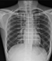 Localisateur cutané médical jetable en forme de grille X pour biopsie par tomodensitométrie, utilisé pour le positionnement chirurgical par tomodensitométrie