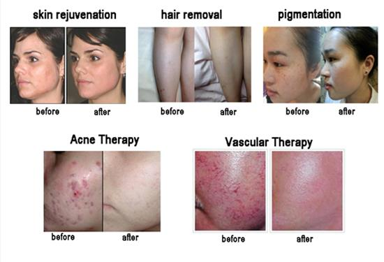 4 In 1 Multifunction Opt Shr Elight Ipl Nd Yag Laser Removal Machine