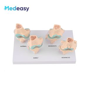 Levensgroot 4-fasen kniegewrichtsmodel Pathologisch anatomisch <span class=keywords><strong>model</strong></span> Schadewaardigheidsdemonstratiemodel Osteoartritismodel voor onderwijs - Product Image 2