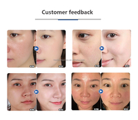 Haute qualité portable Nano pistolet à brouillard soins de la peau EU Jet Peel eau oxygène vaporisateur nez blanchissant perte de poids injecteur facial pulvérisateur