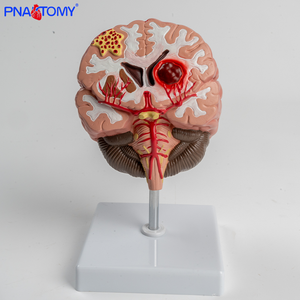 Modelo Anatômico do Cérebro PVC Hemorragia Cerebral e Malformação Arteriovenosa Patologia - Product Image 5