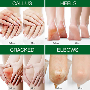 Crème pour les pieds à <span class=keywords><strong>l</strong></span>'<span class=keywords><strong>urée</strong></span> et au beurre <span class=keywords><strong>de</strong></span> karité <span class=keywords><strong>de</strong></span> haute qualité, végane, blanchissante, pour éliminer les peaux mortes des talons, réparation des pieds - Product Image 4