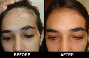 Máquina de <span class=keywords><strong>Tratamiento</strong></span> Efectivo para el Vitiligo, Kernel KN-5000C, Láser Excimer de 308nm, Lámpara Excimer de 308nm, <span class=keywords><strong>Tratamiento</strong></span> Láser para el Vitiligo y la Psoriasis - Product Image 4