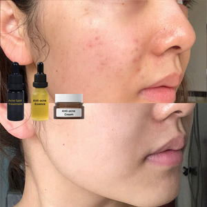 Kem trị mụn trứng cá, làm mờ vết thâm, dưỡng ẩm, loại bỏ mụn trứng cá, sản phẩm bán buôn OEM - Product Image 2