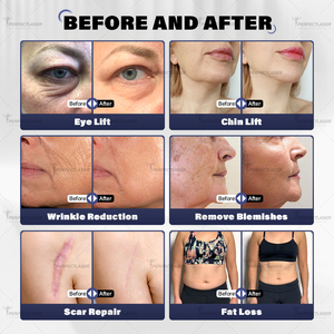 Appareil HIFU 12D pour le remodelage corporel et le lifting du visage, utilisation en salon de beauté, 5 en 1, appareil portable à ultrasons focalisés de haute intensité à vendre - Product Image 6