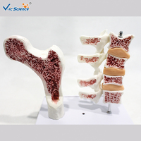 Modelo Anatómico de Patología de Densidad Ósea, Ayuda de Demostración Científica Popular sobre Osteoporosis, CE/ISO/ROHS/CNAS