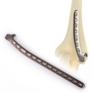 Plaque de fixation humérale CANWELL 02 en titane, distale latérale dorsale, anatomique, pour chirurgie orthopédique traumatique et fractures, certifiée CE, OEM, Classe A - Product Image 2