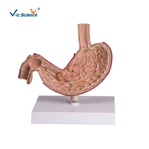 Modelo de Estómago Patológico Humano con Úlcera Cancerosa e Inflamación, para Educación del Paciente, Maniquí Médico - Product Image 1