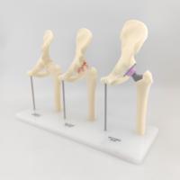 Modèle d'anatomie de l'articulation de la hanche, modèle de comparaison norme, arthrose et remplacement de la hanche, modèle pédagogique médical orthopédique, hauteur 240 mm