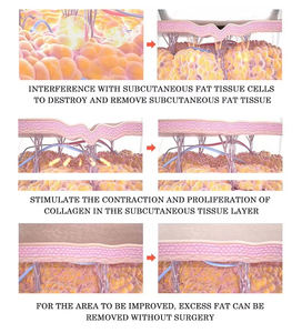 Máquina de Adelgazamiento y Moldeado Corporal Vertical Vela Vacuum con Rodillo de Bolas Interno para Pérdida de Grasa Corporal Completa, Multifuncional, Reafirmante de Piel - Product Image 3