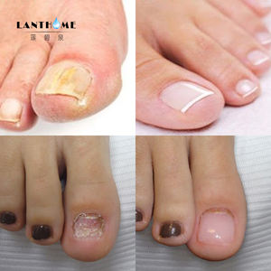 Lanthome-suministros para uñas oem odm, gel de sílice orgánico <span class=keywords><strong>natural</strong></span> para reparación de uñas, tratamiento de hongos en uñas - Product Image 4