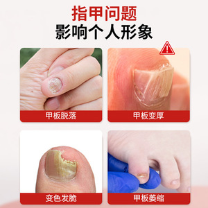 Solución antibacteriana de ácido acético glacial al 30% Dingxin 500ml para el cuidado de los pies y el tratamiento de hongos en las uñas - Product Image 2