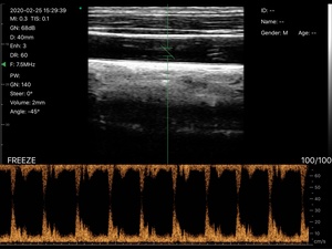 Sonde linéaire sans fil DMU37 à 128 éléments, la plus vendue, avec Doppler couleur pour MSK/Anesthésie/Vascularisation et Hôpitaux - Product Image 6