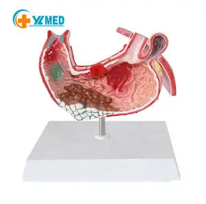 Biology high quality and best price Human Anatomical Diseased Stomach Model for Medical Teaching Anatomy Model