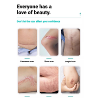 Acné C-Section Hypertrophic Chéloïdes Cicatrices Réparation des Cicatrices Gel Crème-Chirurgie Brûlures Crème d'élimination des vergetures