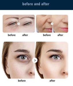 หัว FLX รุ่นที่ 5 สำหรับการรักษาด้วยความร้อน หัว FLX เครื่องมือความร้อน กระตุ้นคอลลาเจน ลดรูขุมขน กระชับผิว - Product Image 5