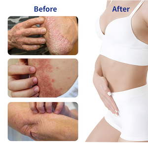 Crème pour l'eczéma à marque privée OEM, éclaircissante, à base de plantes, antifongique, apaisante en profondeur, pour le corps, nouvelle formule chinoise, meilleure crème anti-démangeaisons, CE - Product Image 4
