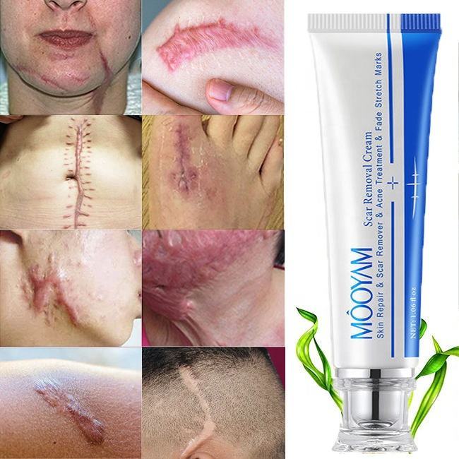 MOOYAM Powerful Stretch Marks Remover Skin
