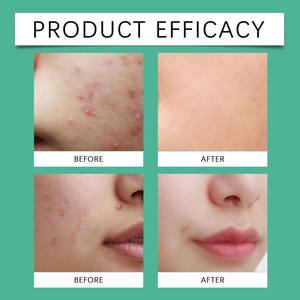 <span class=keywords><strong>Patch</strong></span> Original <span class=keywords><strong>Patch</strong></span> Hydro kolloid Akne Pickel Patches für Gesicht Schrumpfende Zits & Whiteheads Spot Pickel Aufkleber für Gesicht - Product Image 4