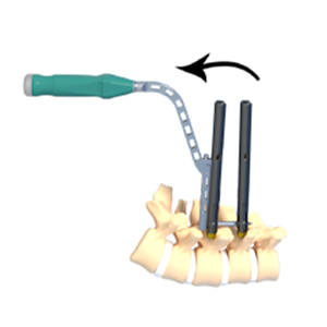 China produceert titanium orthopedische chirurgische implantaten, 5,5 mm systeem, monoaxiale pedikelschroef voor wervelkolomfixatiechirurgie, Fule. - Product Image 1