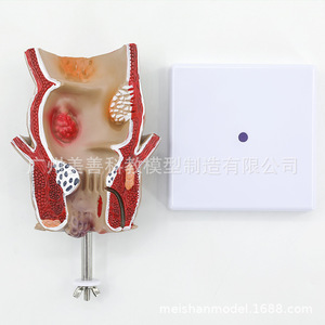Modèle de hémorroïdes rectales et de lésions colorectales ; hémorroïdes rectales internes et externes et modèle anorectal ; pathologie rectale. - Product Image 3