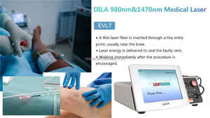 EVLT EVLA Flebología Venas Varicosas Coagulación Láser Endovenoso EVLC Fibra Láser 980nm 1470nm Sistema de Ablación Láser - Product Image 5