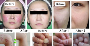 Tần Số Cao Cautery Vẻ Đẹp Thiết Bị Cho Spider Tĩnh Mạch Da Tag Loại Bỏ Mạch Máu Tẩy Tế Bào Chết Và Trẻ Hóa Máy - Product Image 6