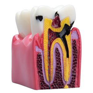Modelo Educativo Dental: Comparación Bilateral de Caries, Modelo de Demostración Transversal 6 Veces Ampliada, Accesorios para la Enseñanza de la Decidencia Dental - Product Image 1