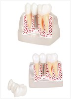 Modèle d'anatomie d'implant dentaire amovible à 3 couches |   Modèle pédagogique pour les étudiants en dentisterie et les cliniques |   Structure Démontable