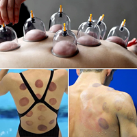 Ensemble professionnel de ventouses chinoises Hijama, kit de thérapie par ventouses sous vide pour la réduction de la cellulite et le soulagement des douleurs musculaires