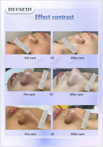 Appareil de microdermabrasion <span class=keywords><strong>Aqua</strong></span> Hydro 10 en 1, nettoyage par bulles, dermabrasion H2O2, soin du visage pour salon - Product Image 4
