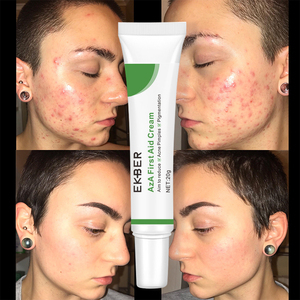 Crème de traitement de l'acné EKBER OEM BHA, élimine les points noirs, les comédons fermés, les éruptions cutanées rouges, contrôle le sébum, atténue les marques d'acné, crème pour le visage - Product Image 5