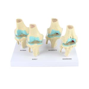 Modèle d'articulation du genou, anatomie humaine, modèle de genou pour l'enseignement de la pathologie, 4 étapes - Product Image 1