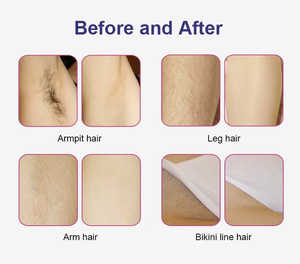 Portable Permanent Armpit Body <b>Hair</b> <b>Removal</b> 808nm <b>Diode</b> <b>Laser</b> <b>Hair</b> <b>Removal</b> <b>Machine</b> - Product Image 6