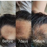 Exozome Stem Cell Scalp Booster Facteurs de restauration du cuir chevelu et des cheveux Ampoule Solution de rajeunissement des cheveux et du cuir chevelu Réparation des racines des cheveux B