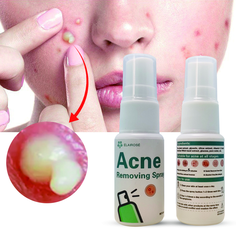 Acne Remoção Rosto Spray Extratos naturais de plantas Acne Spots Tratamento Oil Control Cuidados com a pele Acne Removal Spray