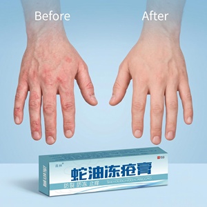 <span class=keywords><strong>Crema</strong></span> Invernale <span class=keywords><strong>per</strong></span> Prevenire le Scottature 15g, Balsamo Nutriente Antibatterico <span class=keywords><strong>per</strong></span> Mani e Piedi, Formula Naturale a Base di Erbe, Vendita all'Ingrosso - Product Image 3